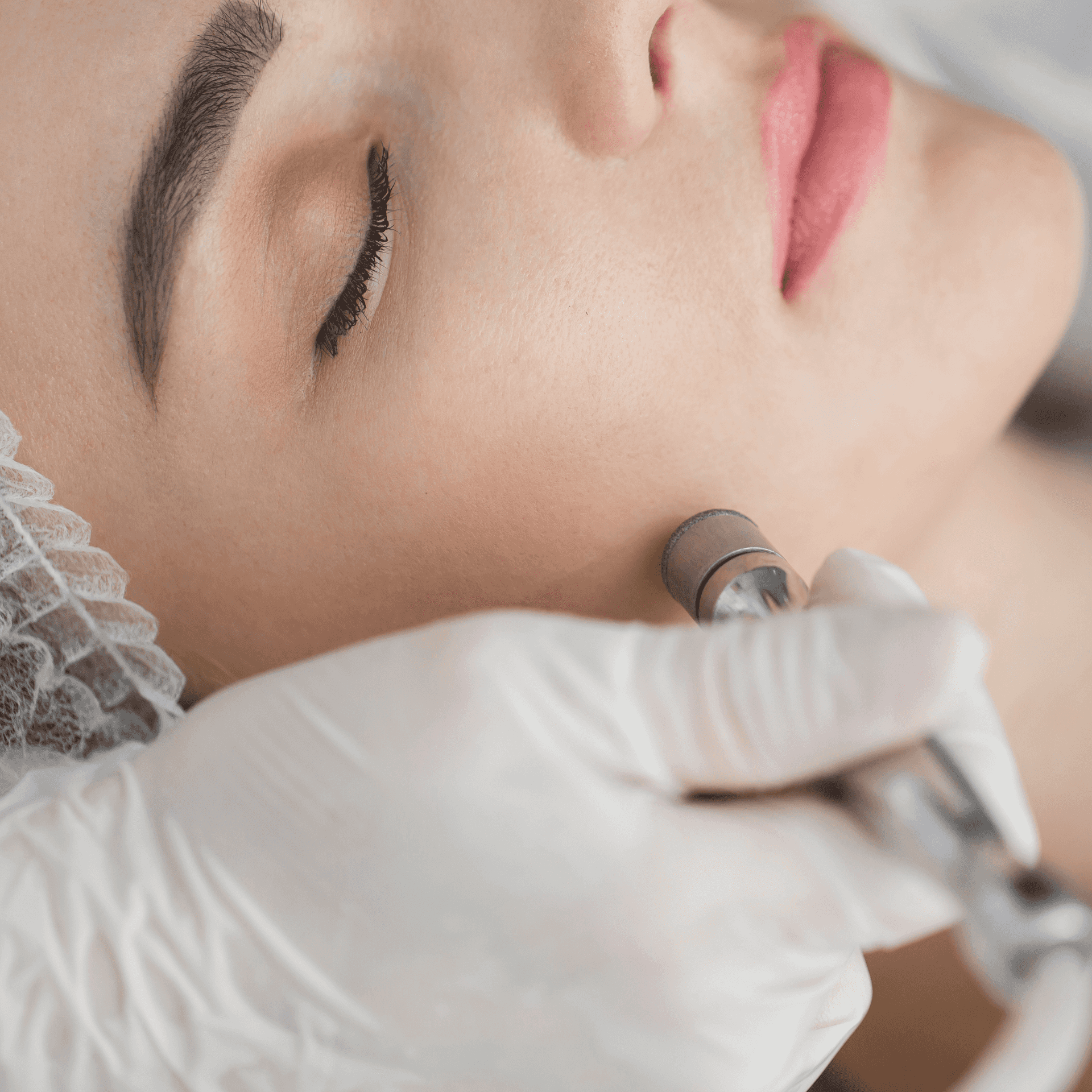 Microdermabrasion in Trussville